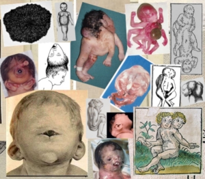 CRANIORACHISCHISIS - CD - Craniorachischisis